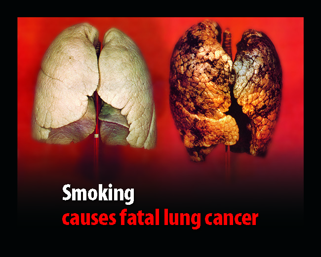 UK 2008 Health Effects lung - diseased organ, lung cancer, gross